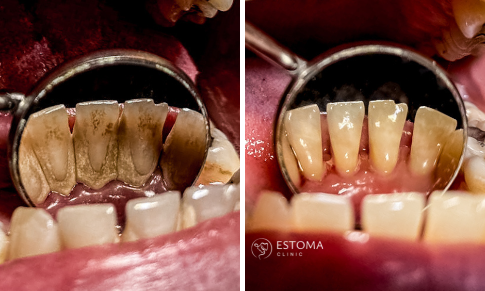 Před Air-Flow čištěním - pigmentace na zubech