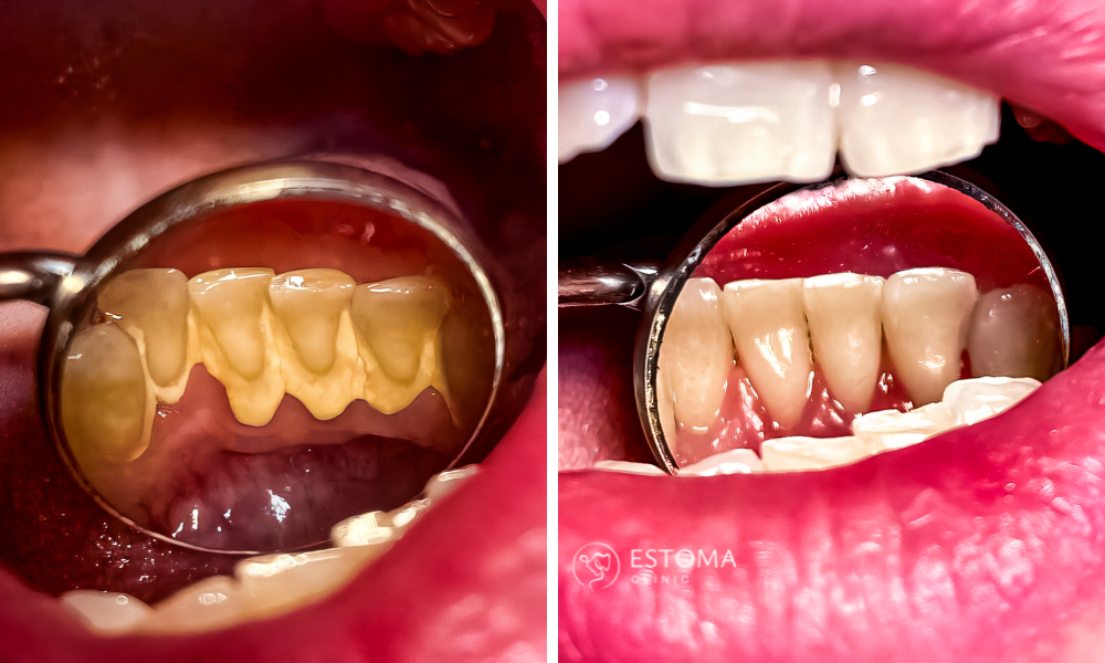 Po Air-Flow čištění - čisté bílé zuby