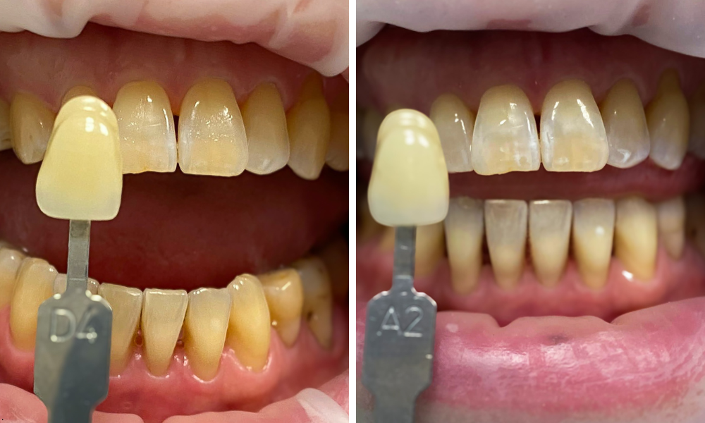 Biochemický princip bělení zubů