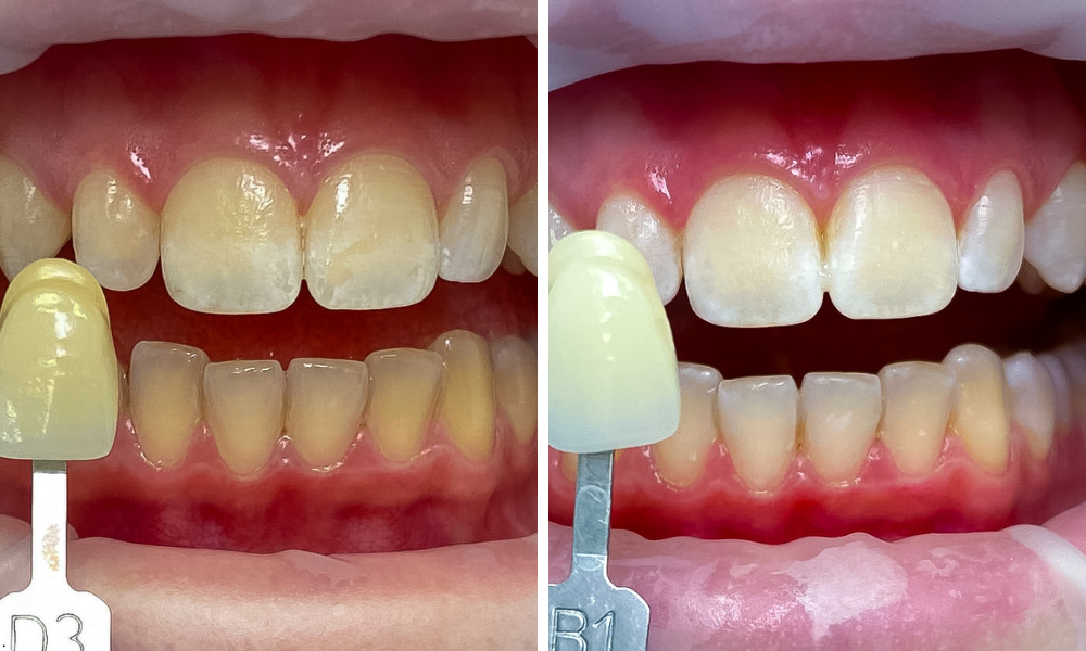 Bezpečnost ordinačního bělení