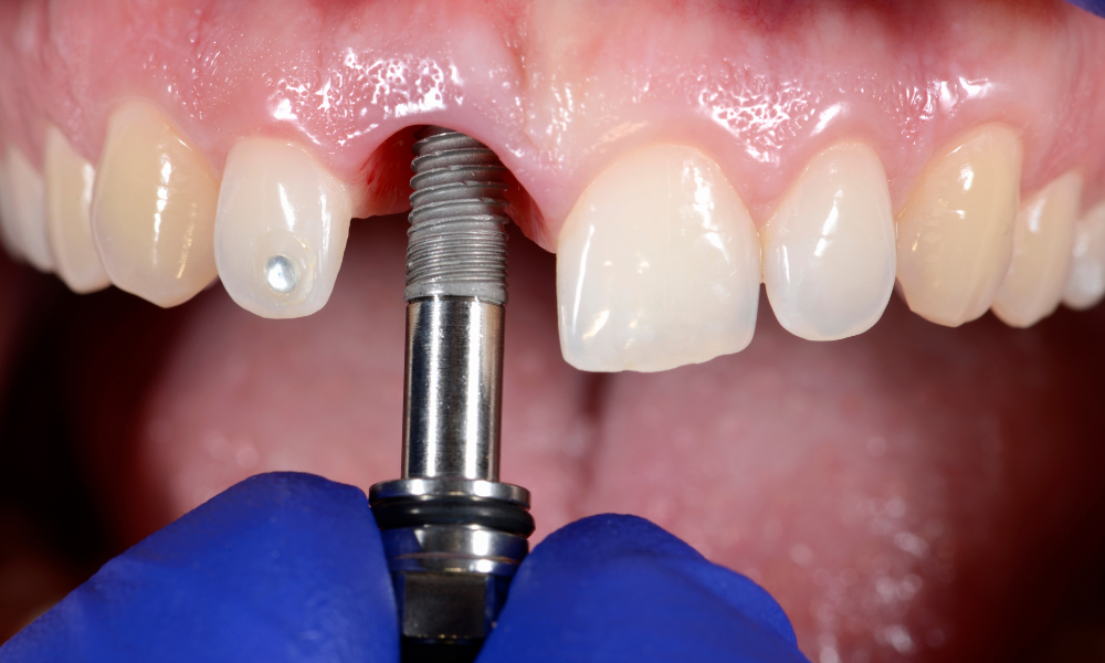Nahrazení zubu implantátem