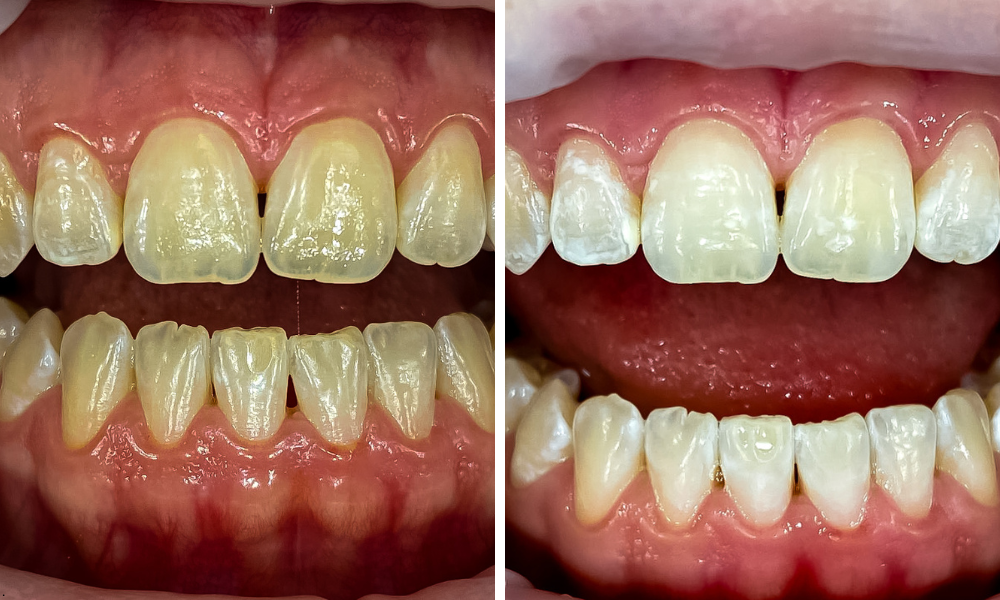 Účinnost ordinačního bělení