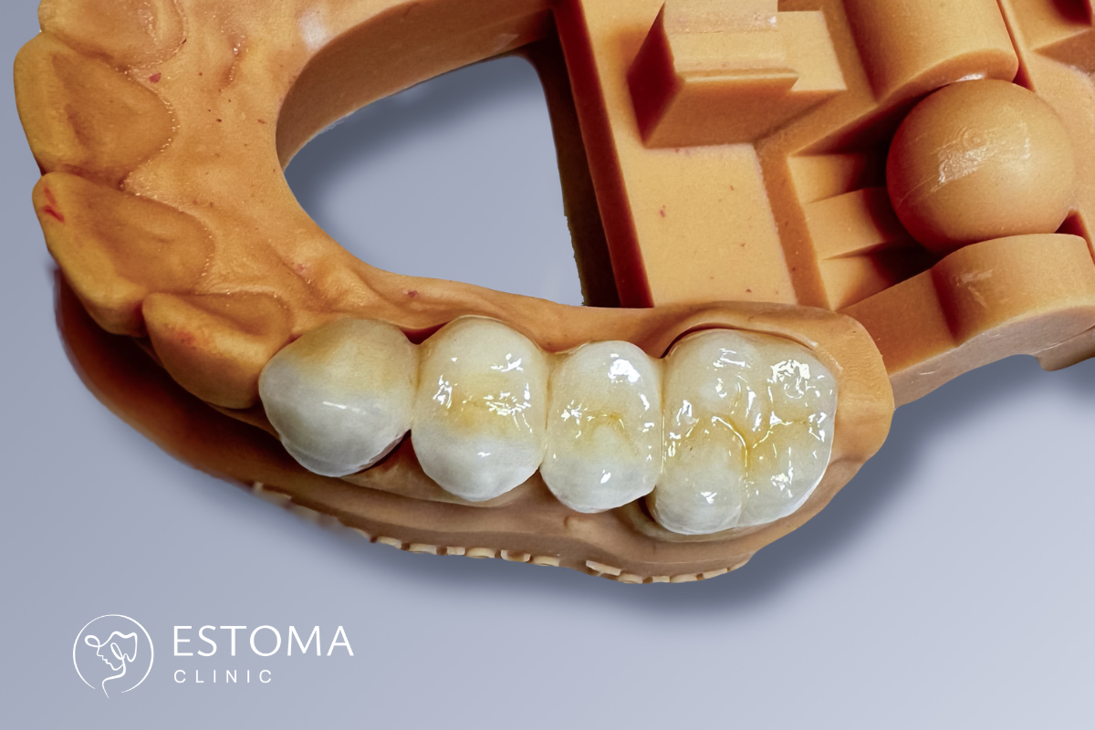 Zubní můstky – jak fungují, jaké existují typy a jak obstojí ve srovnání s implantáty
