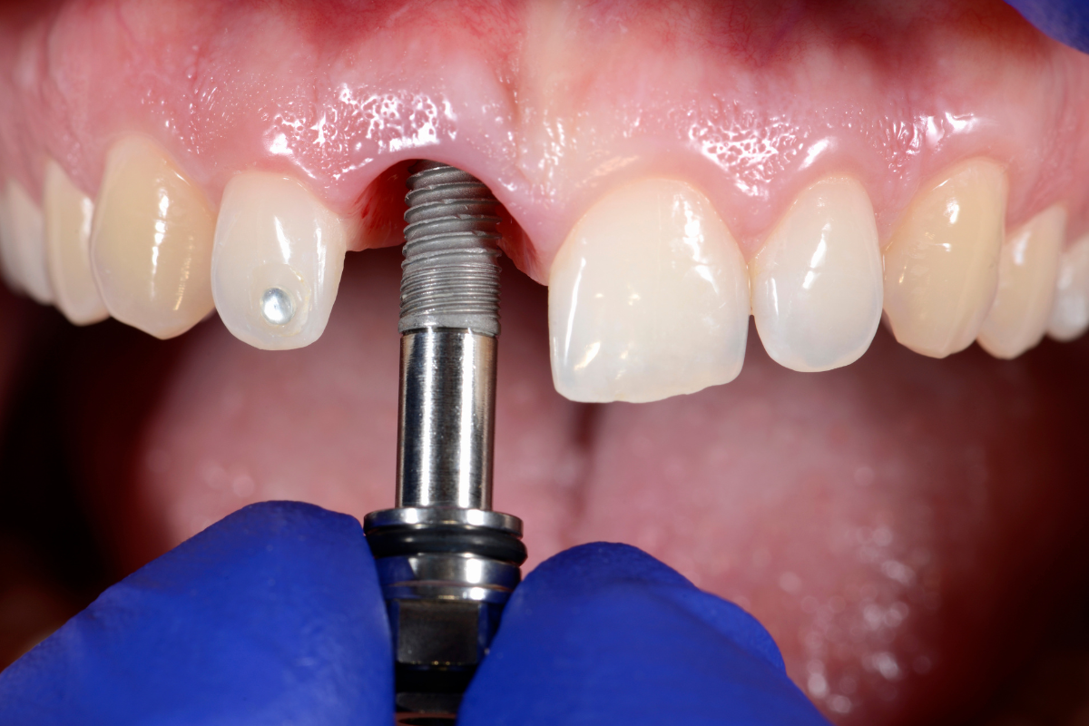 Jak prodloužit životnost zubních implantátů? Vědecky podložený přehled pro pacienty