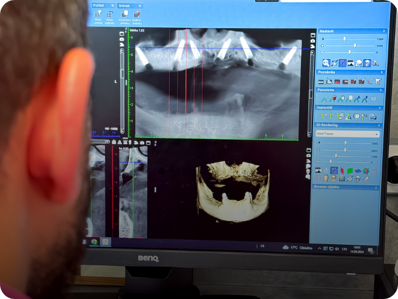 Moderní náhrady zubů