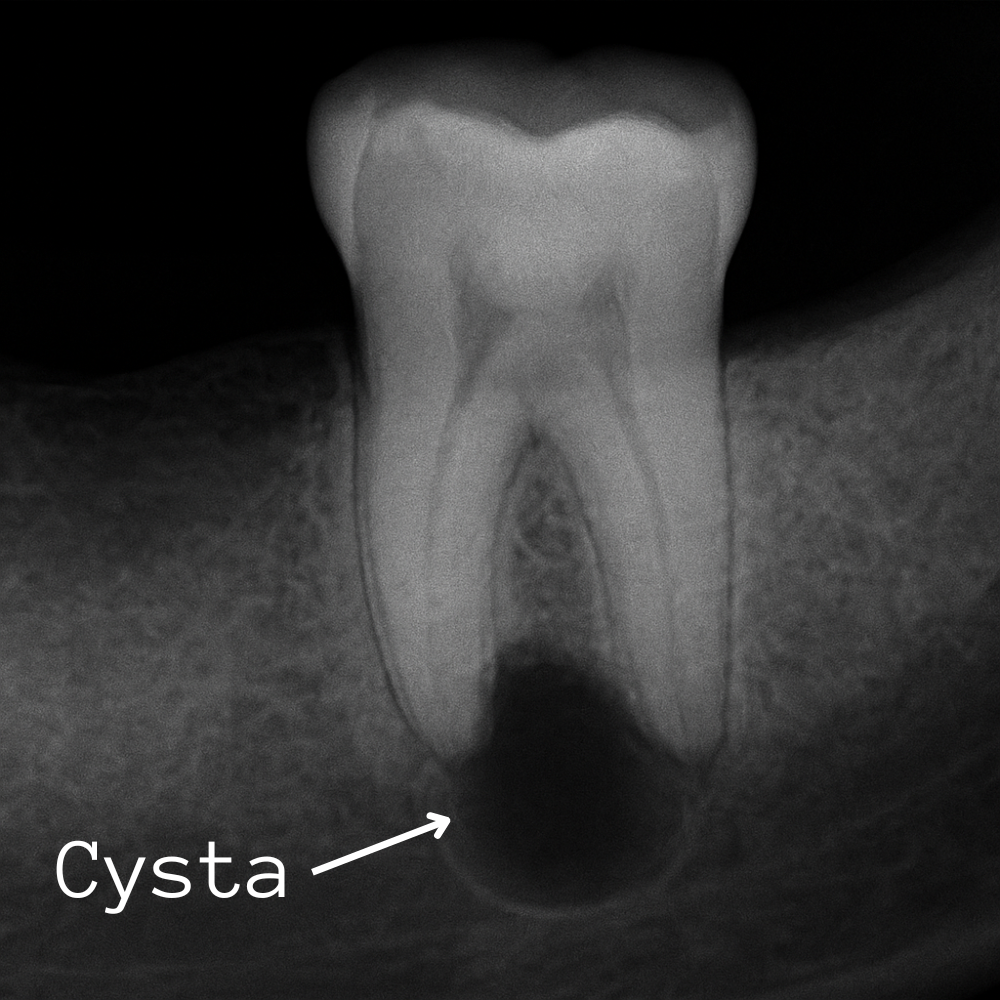 Zub bez nervu s váčkem u kořene - zánět