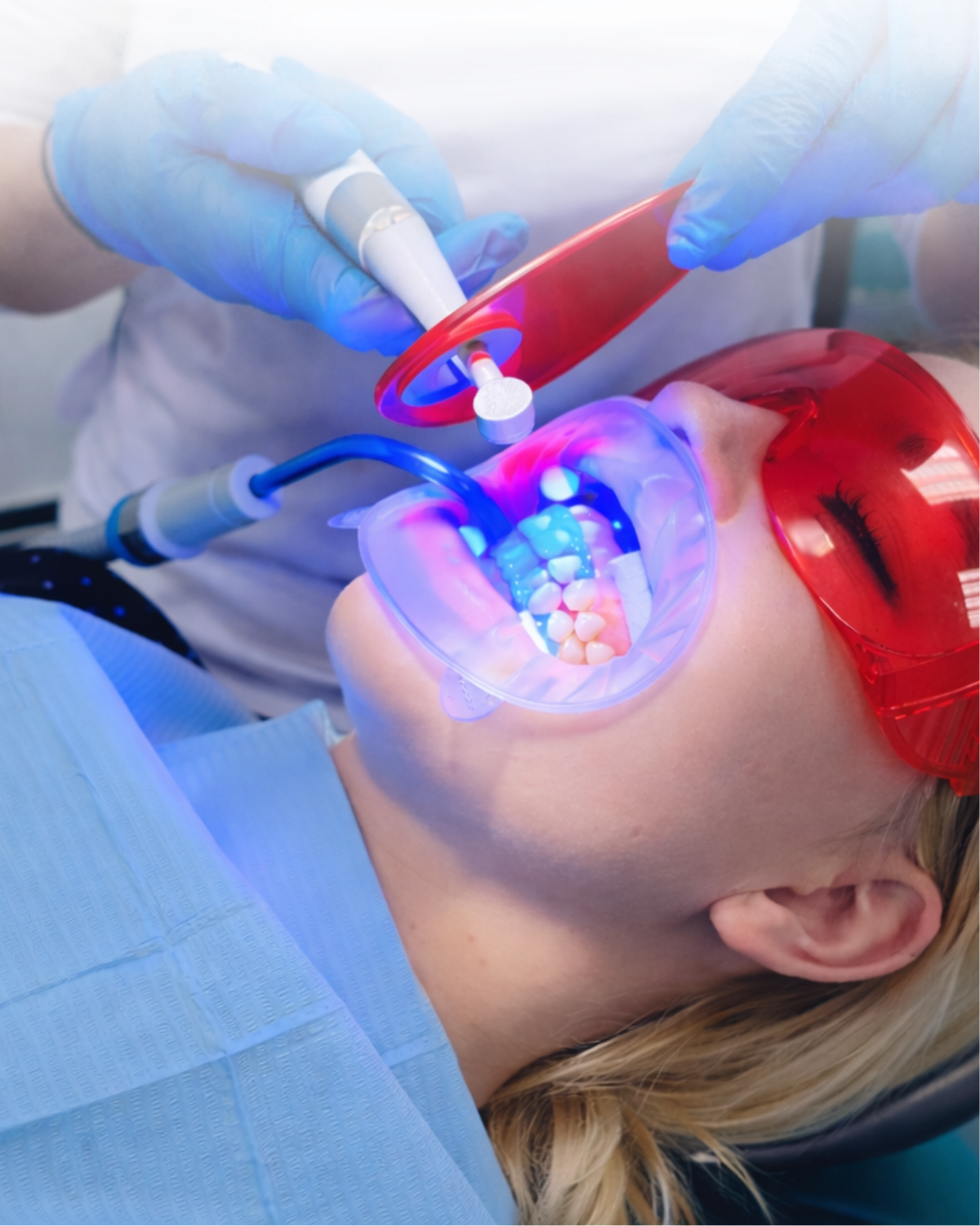 Profesionální bělení zubů výsledek — Estoma Clinic