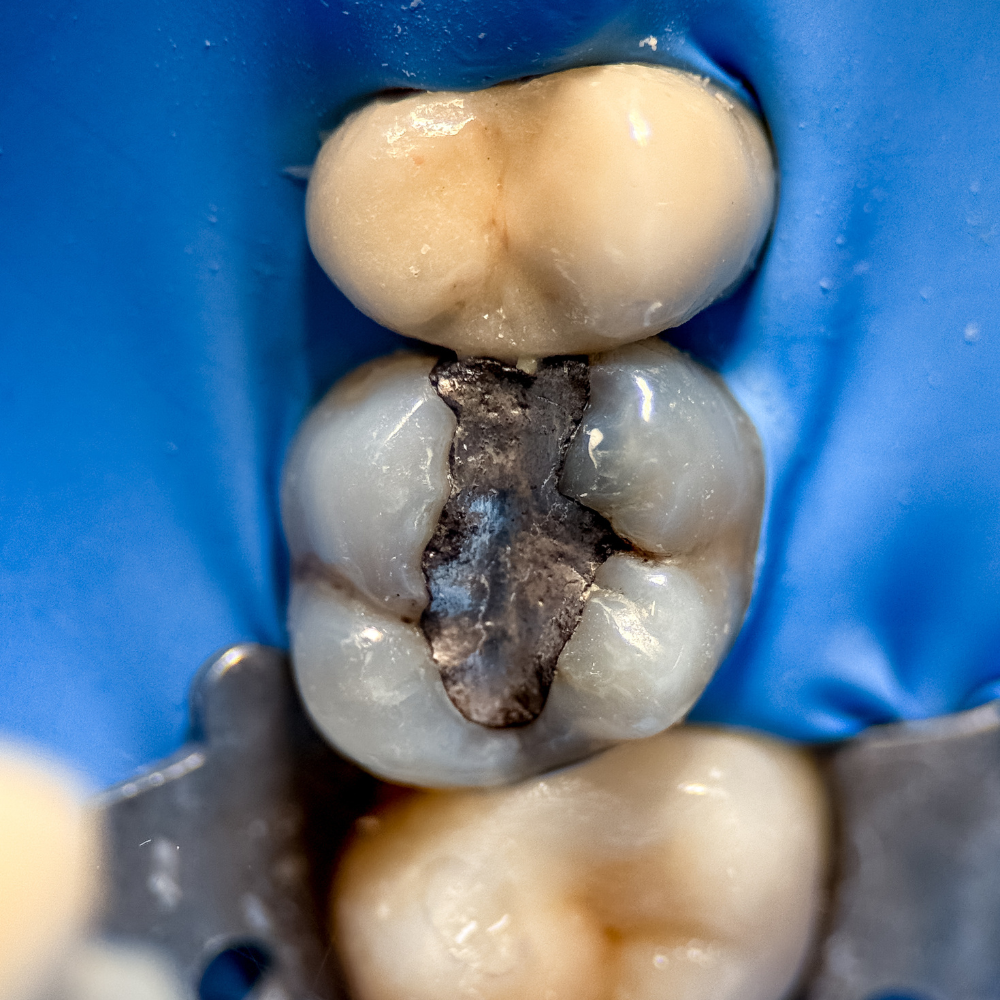 Špatně sedící výplň nebo korunka na zubu