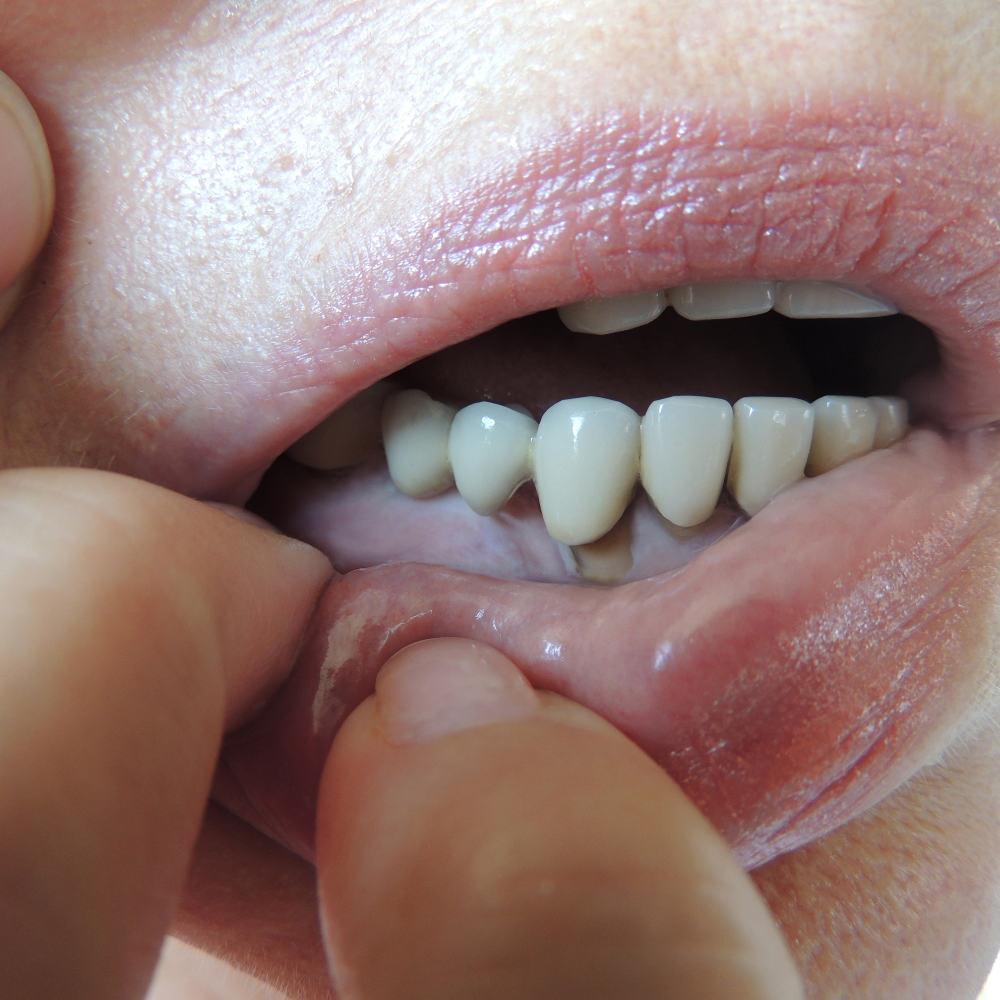 Kontaminace korunky slinami