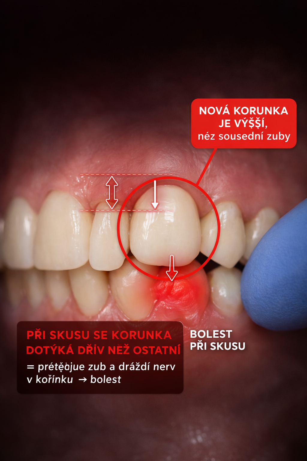 Přetížení nové zubní korunky — Estoma Clinic