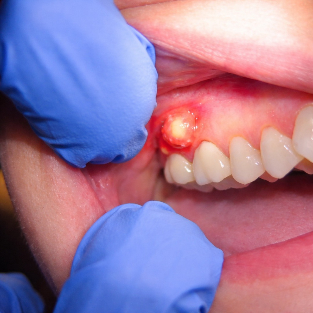 Zubní absces (zubní váček) – příčiny, příznaky, léčba a prevence