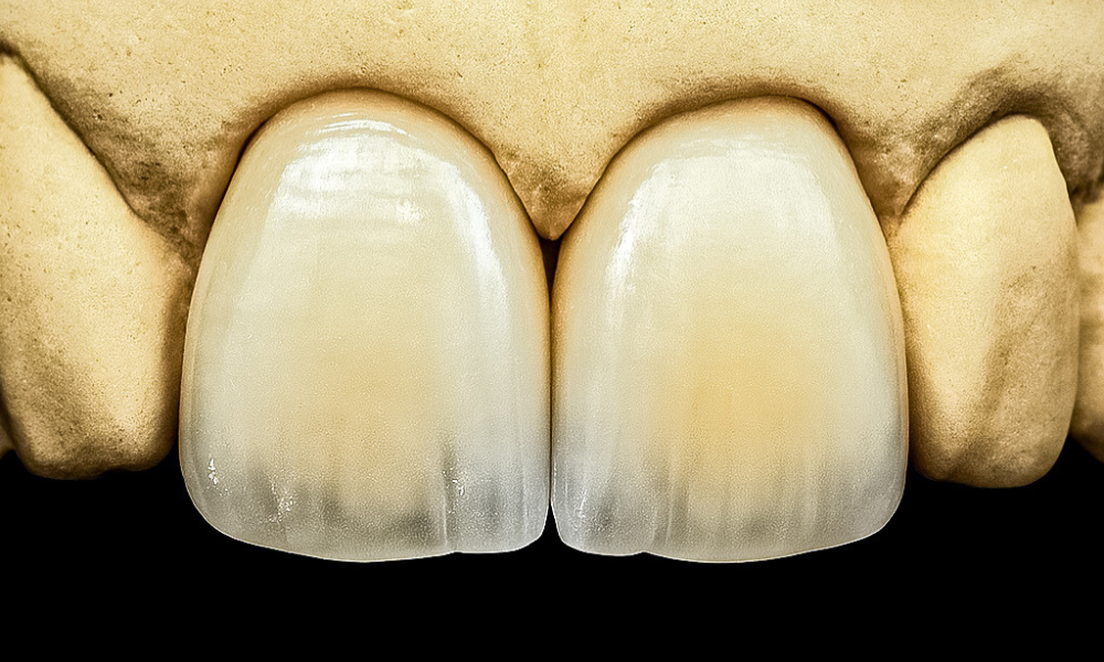 Přirozený vzhled keramických fazet