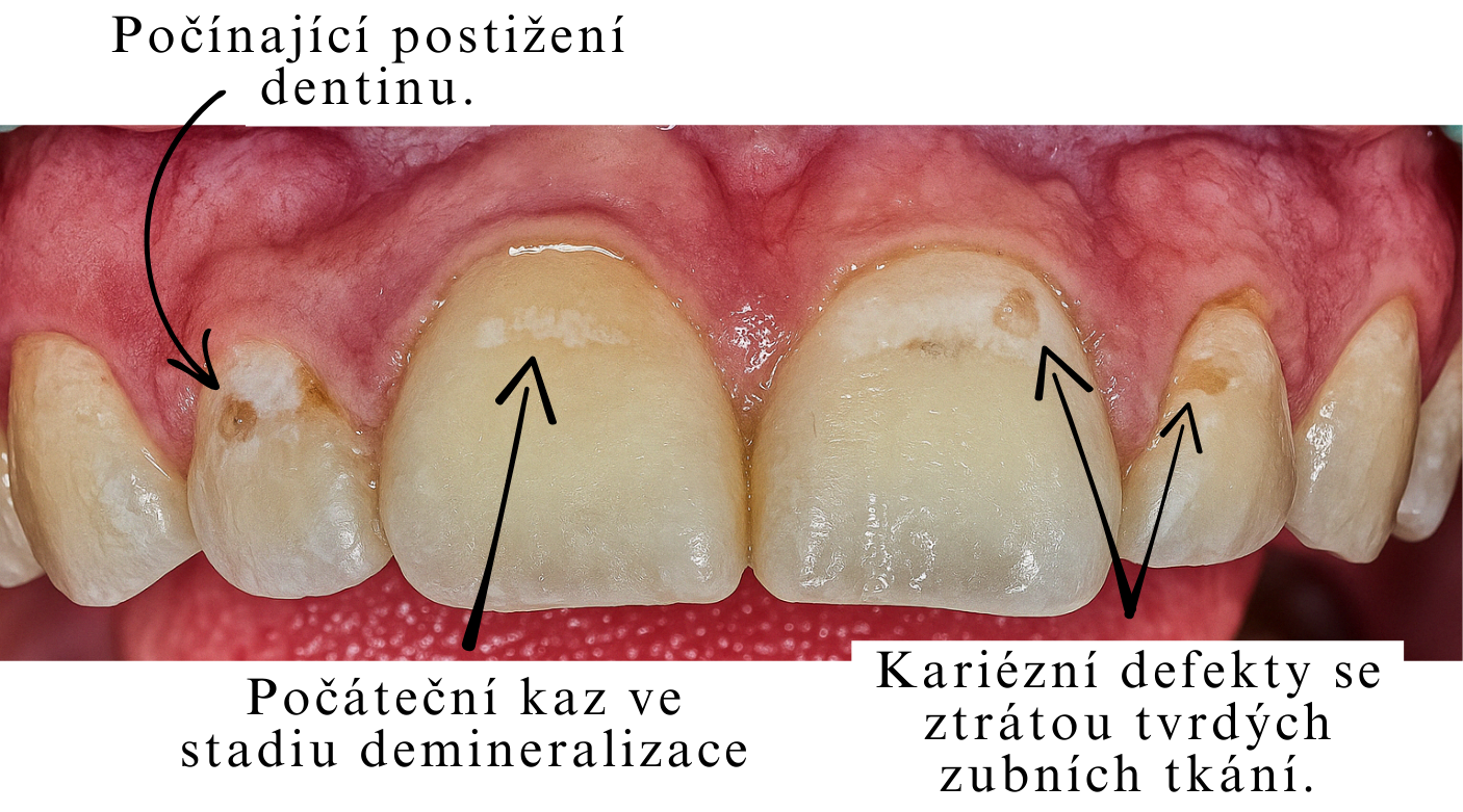 Vizuální projevy zubního kazu