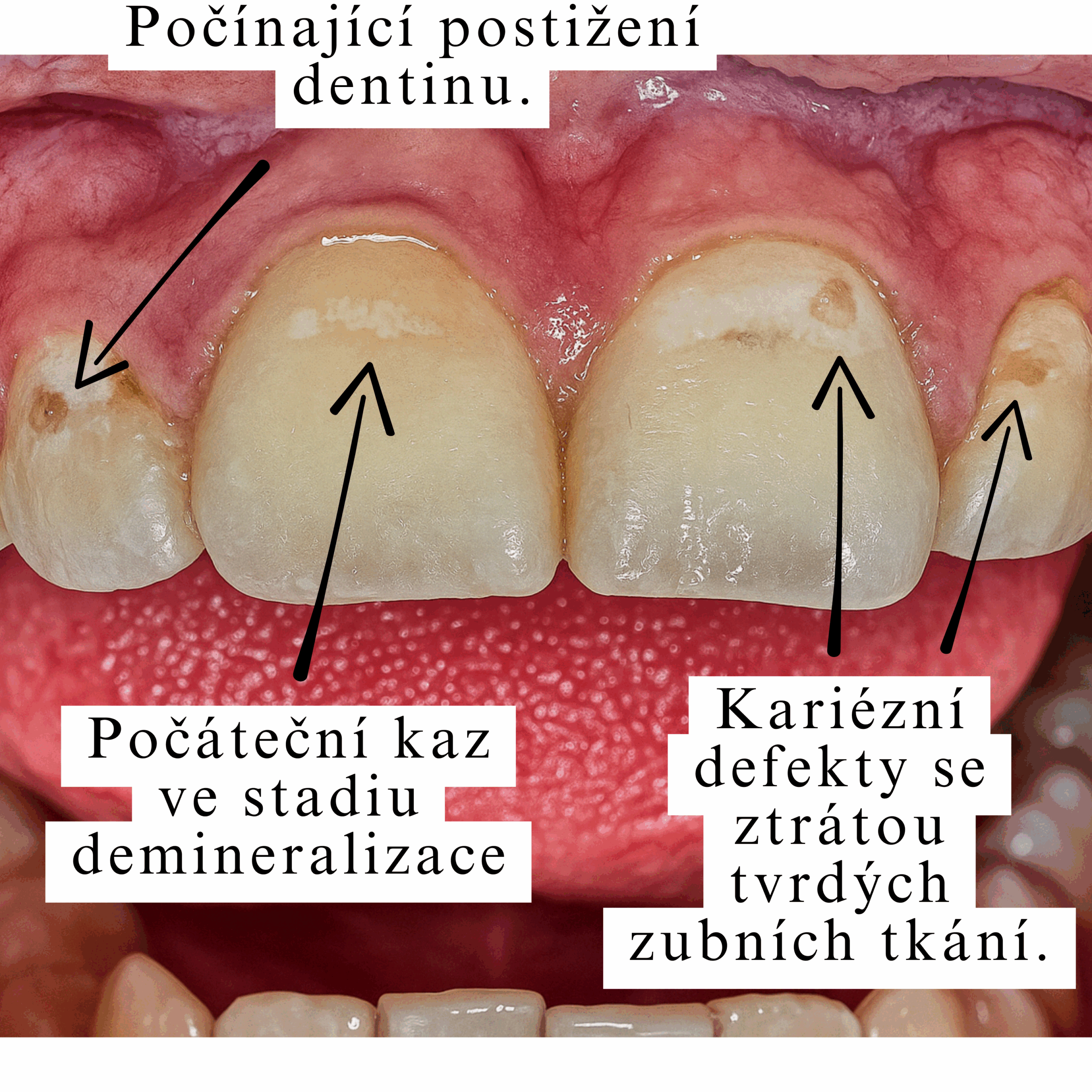 Počáteční kaz ve stádiu demineralizace