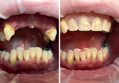 Typy nylonových protéz