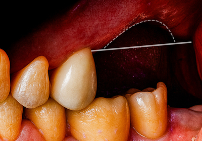 Úbytek kostní hmoty