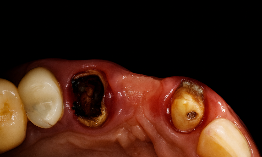 Změna tvaru zubu pod korunkou