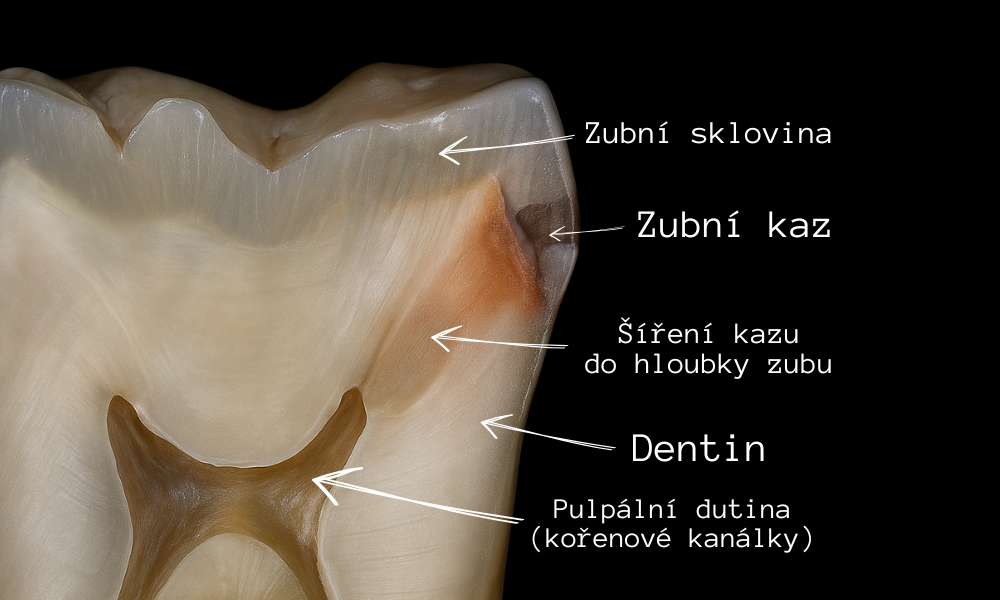 Stádia zubního kazu