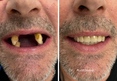 Indikace pro nylonové protézy