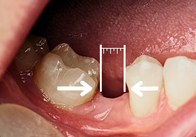 Jak dlouho lze být bez zubu, aniž by to poškodilo chrup?
