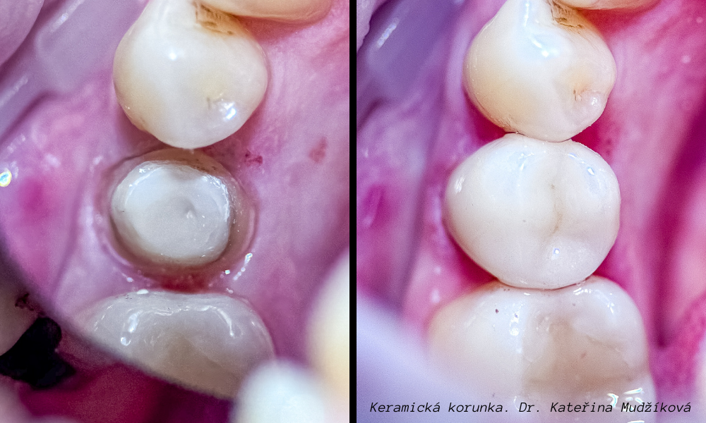 Rozdíly mezi keramickými a kovovými korunkami