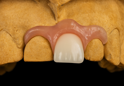 Nylonové zubní protézy: výhody, nevýhody a pro koho jsou vhodné