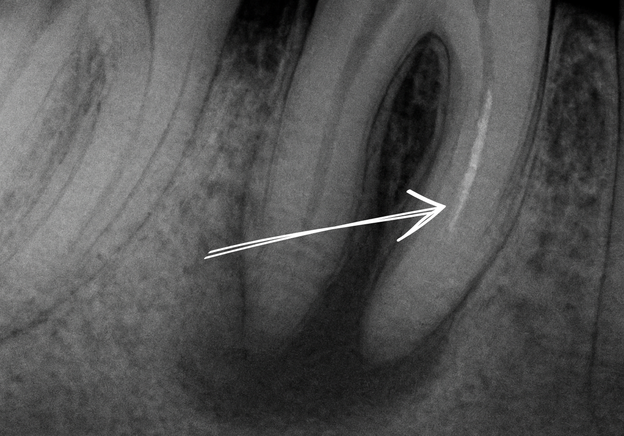 Zlomený nástroj v kanálku