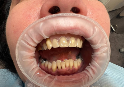 Shrnutí nylonových protéz