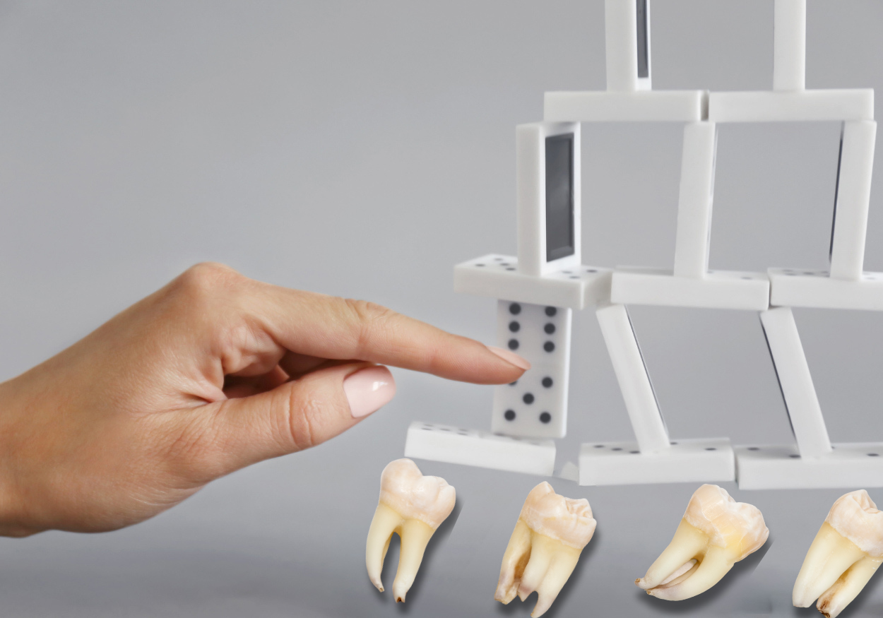 Domino efekt ztráty zubů