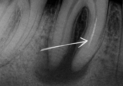 Zlomený nástroj v kořenovém kanálku — Estoma Clinic