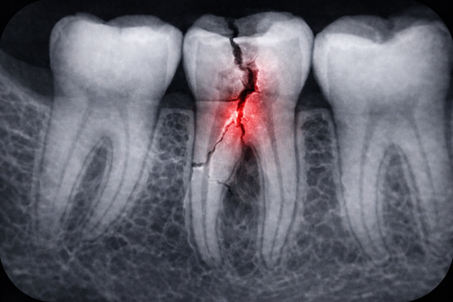 Korunka s čepem – ošetření — Estoma Clinic