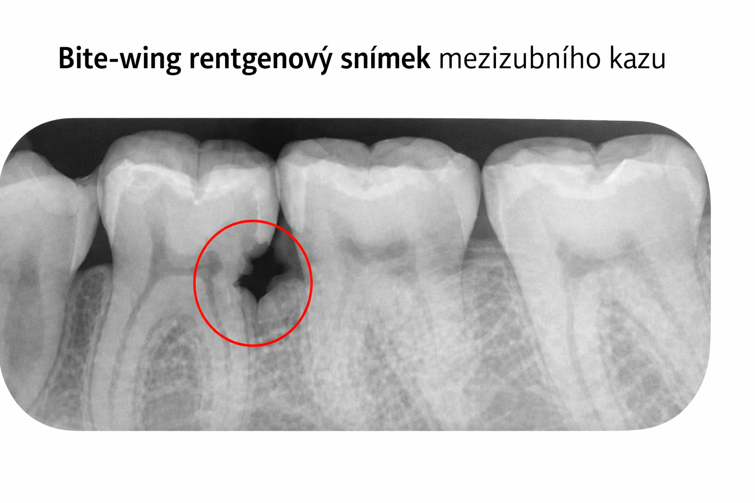 Zubař pořizuje bite-wing rentgenový snímek