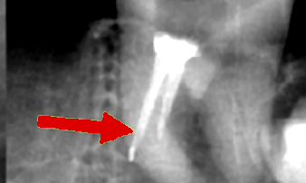 Perforace kořene na RTG snímku — Estoma Clinic
