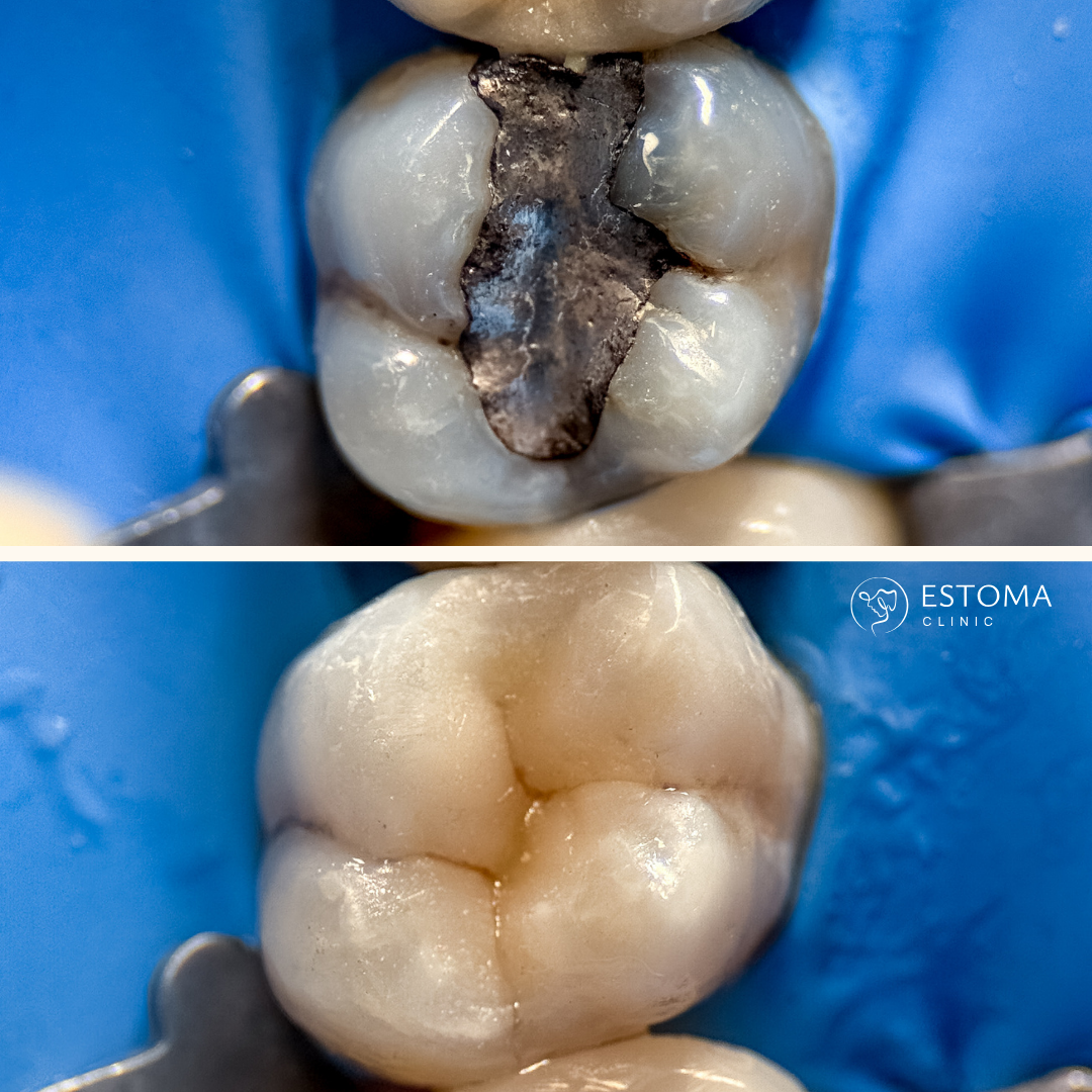 Srovnání amalgámových a kompozitních výplní — Estoma Clinic