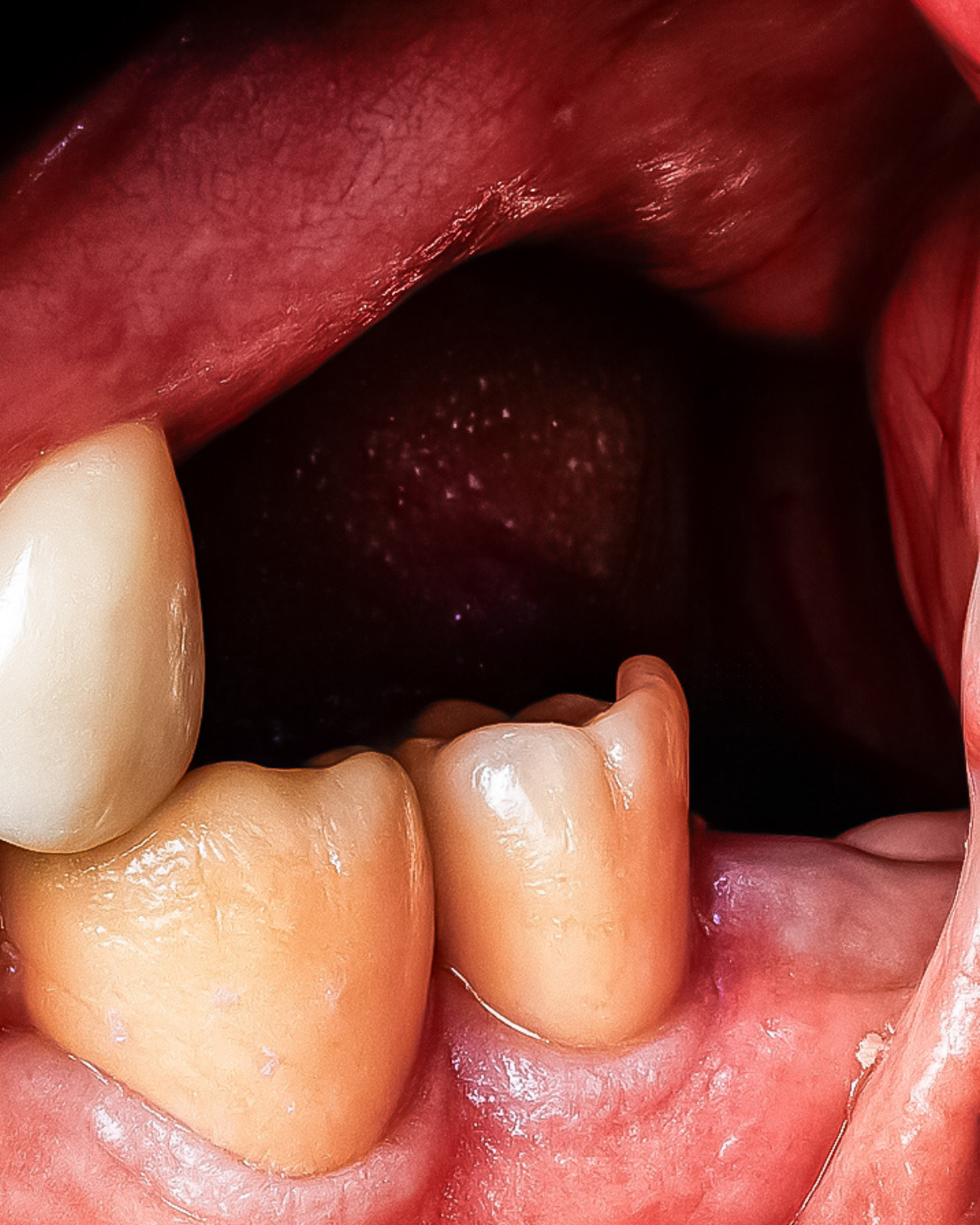 Posuny zubů a změna skusu po ztrátě zubu — Estoma Clinic