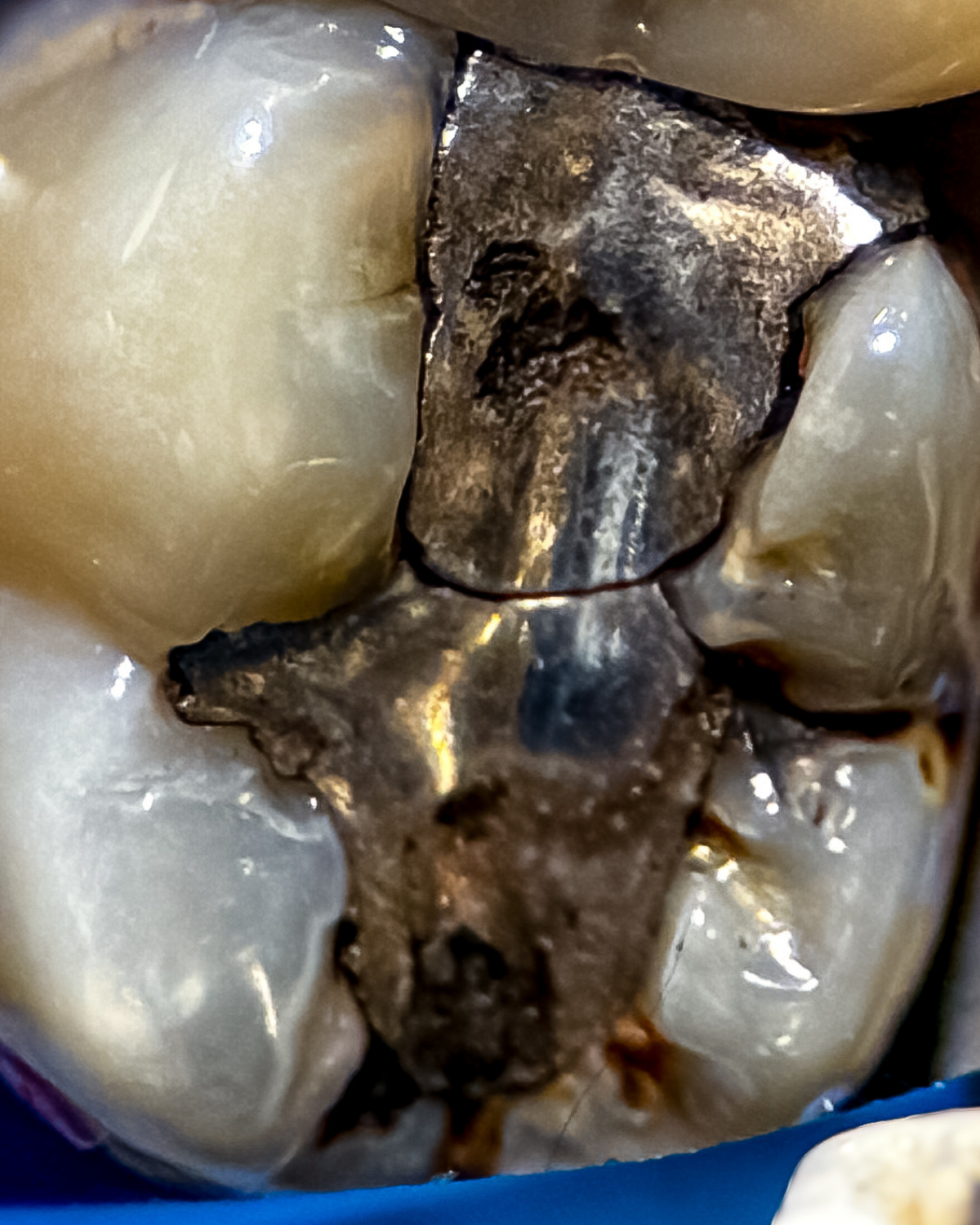 Sekundární kaz pod výplní — Estoma Clinic