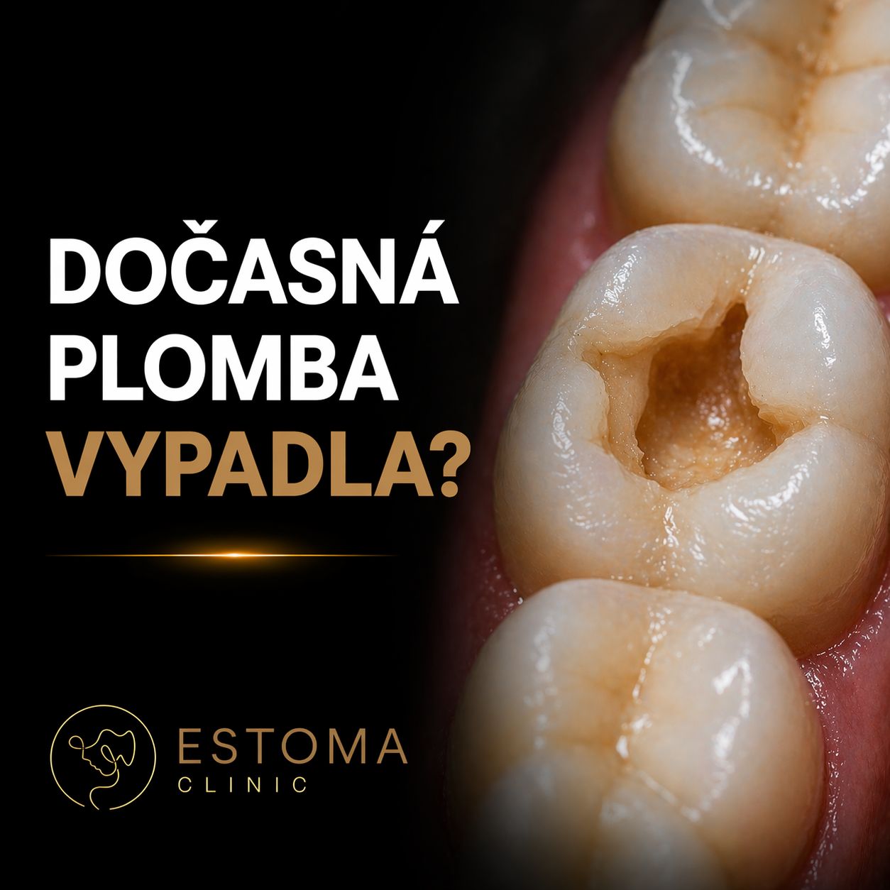Dočasná plomba vypadla? Co dělat hned a kdy jít k zubaři