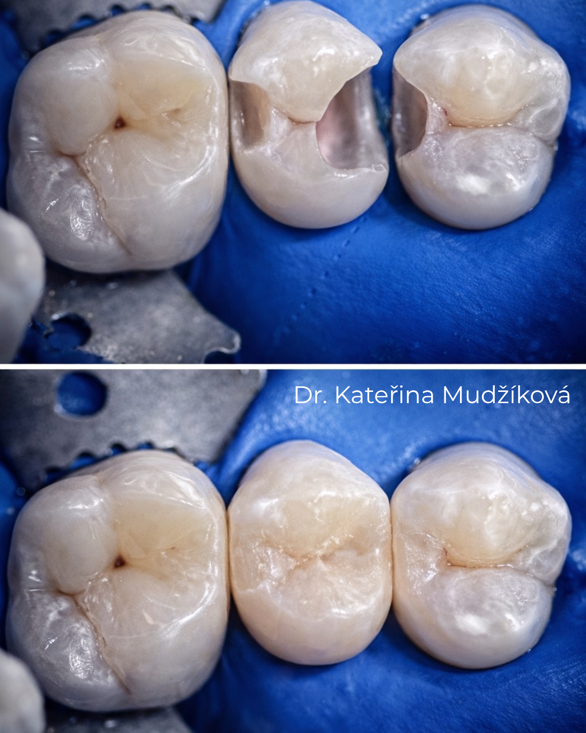 Chyby při vypadlé výplni — Estoma Clinic