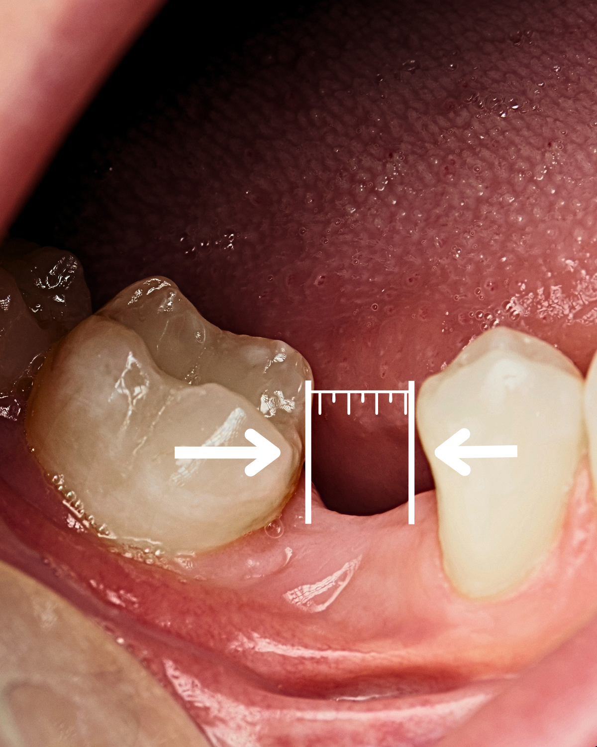 Posuny zubů k mezeře – nedostatek místa pro implantát — Estoma Clinic