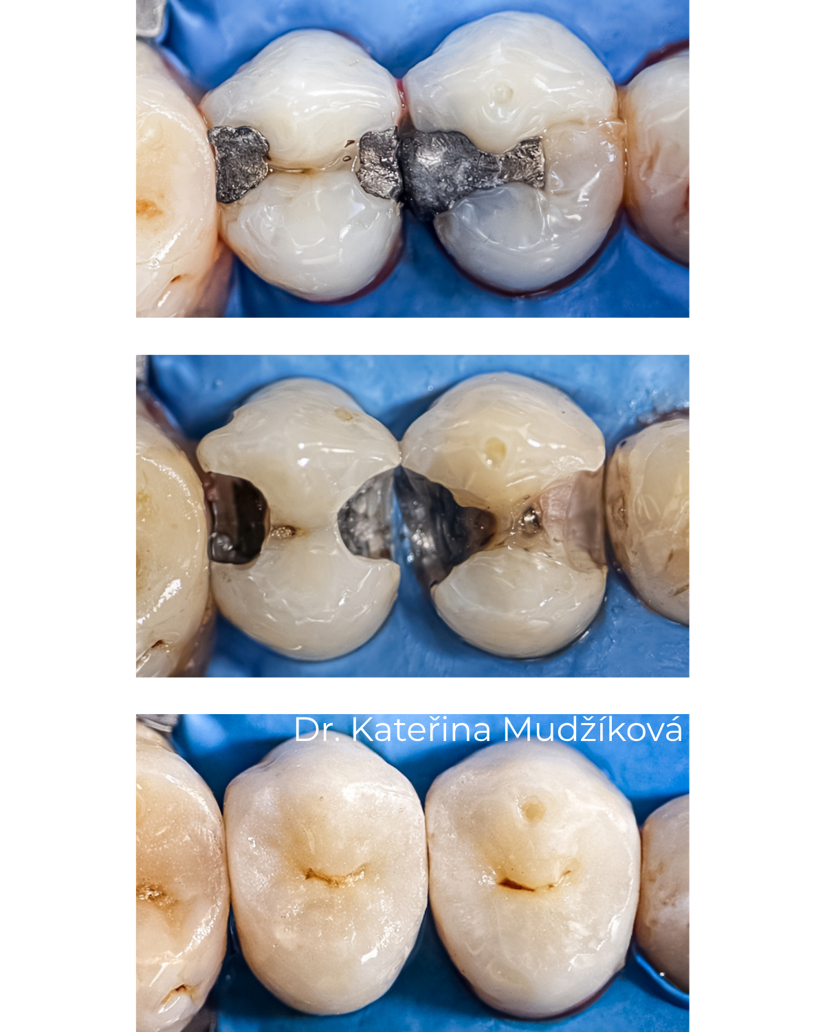 Co dělat po vypadnutí výplně — Estoma Clinic