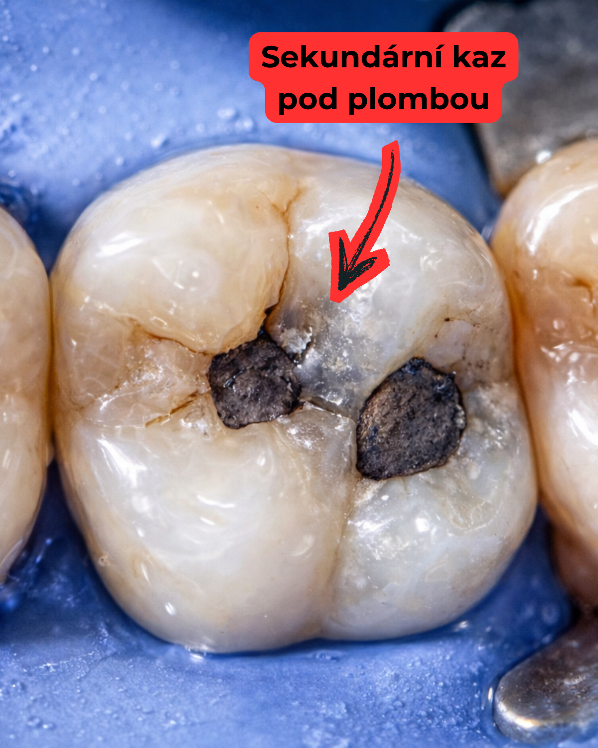 Příčiny vypadnutí výplně — Estoma Clinic