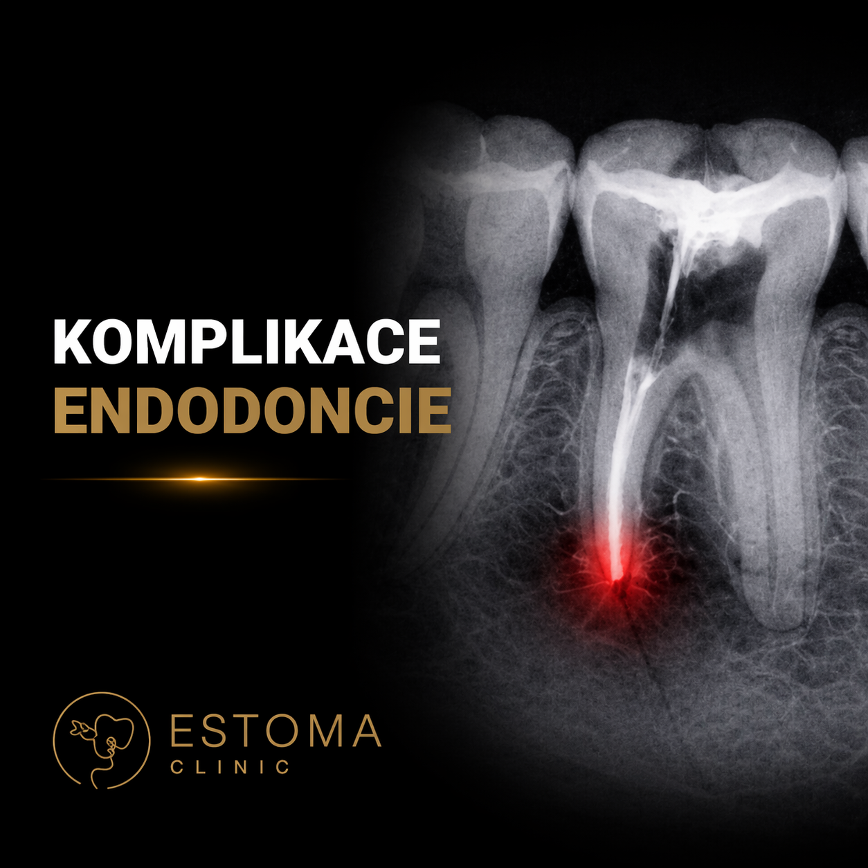Komplikace endodoncie