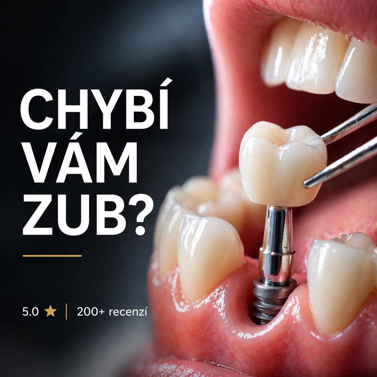 Chybí vám zub? Jak dlouho můžete čekat, než vzniknou nevratné změny