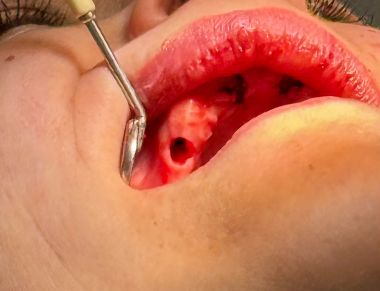 Jak dlouho bez zubu – následky — Estoma Clinic