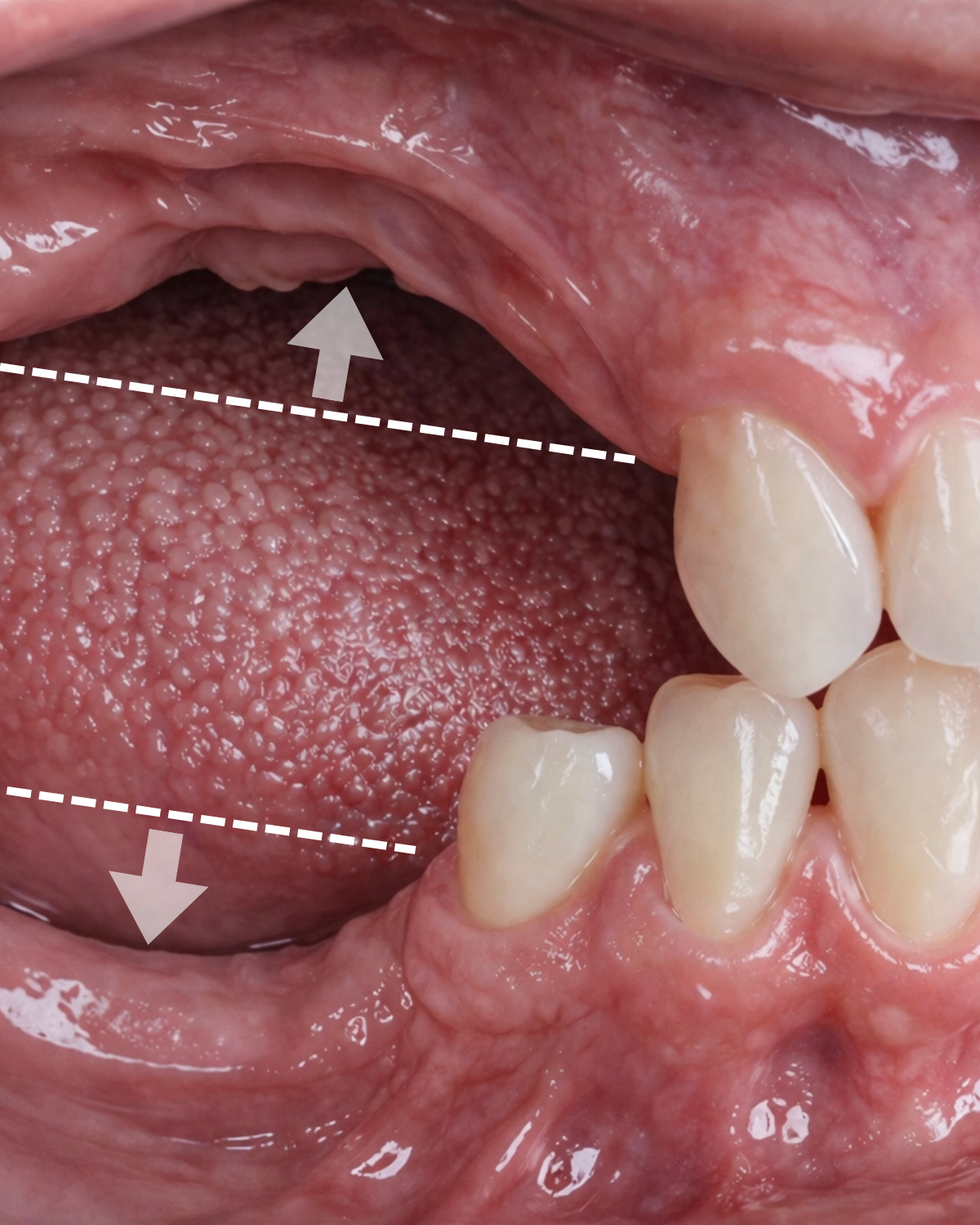 Kostní atrofie po ztrátě zubu — Estoma Clinic