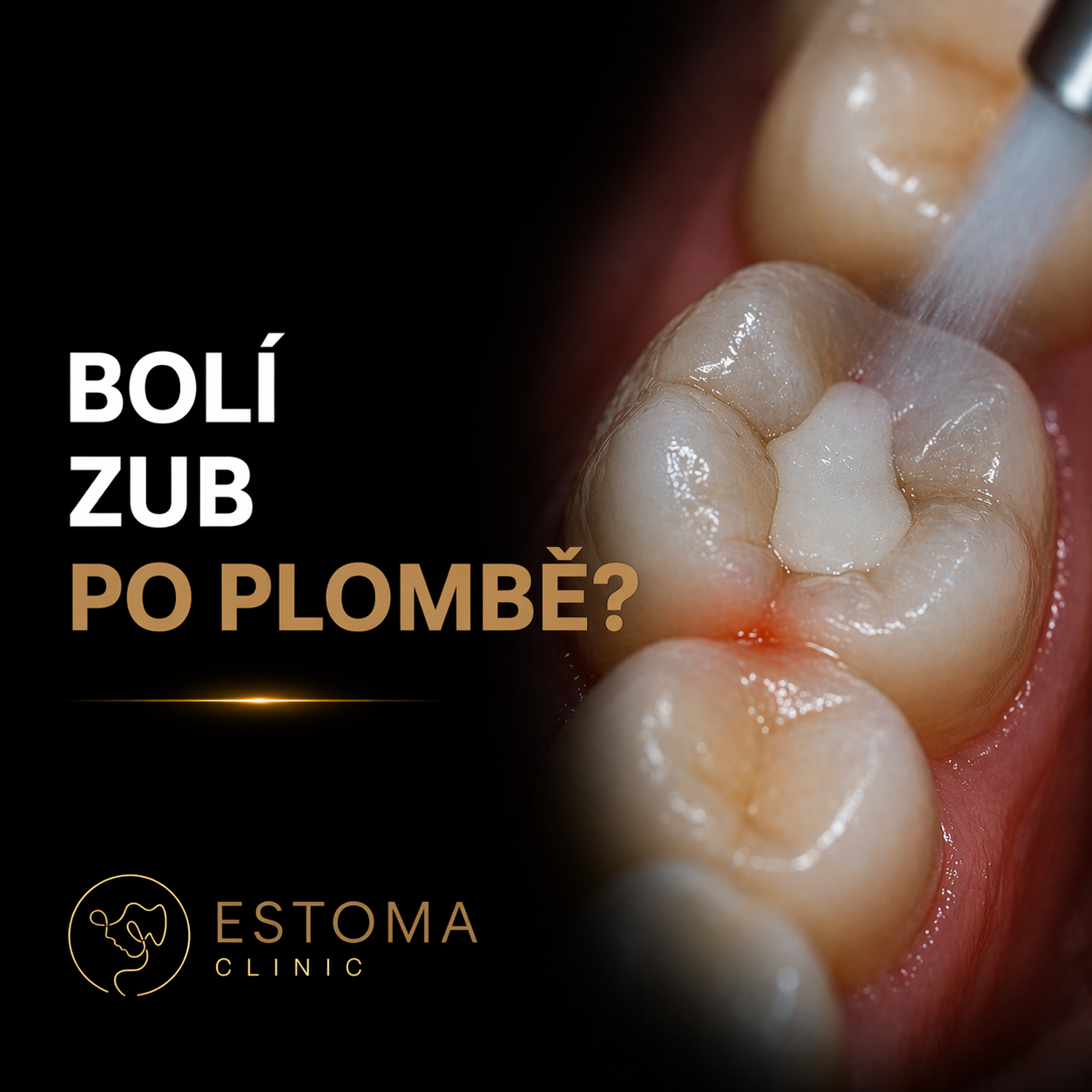 Bolí zub po plombě? Zjistíme příčinu a rychle pomůžeme