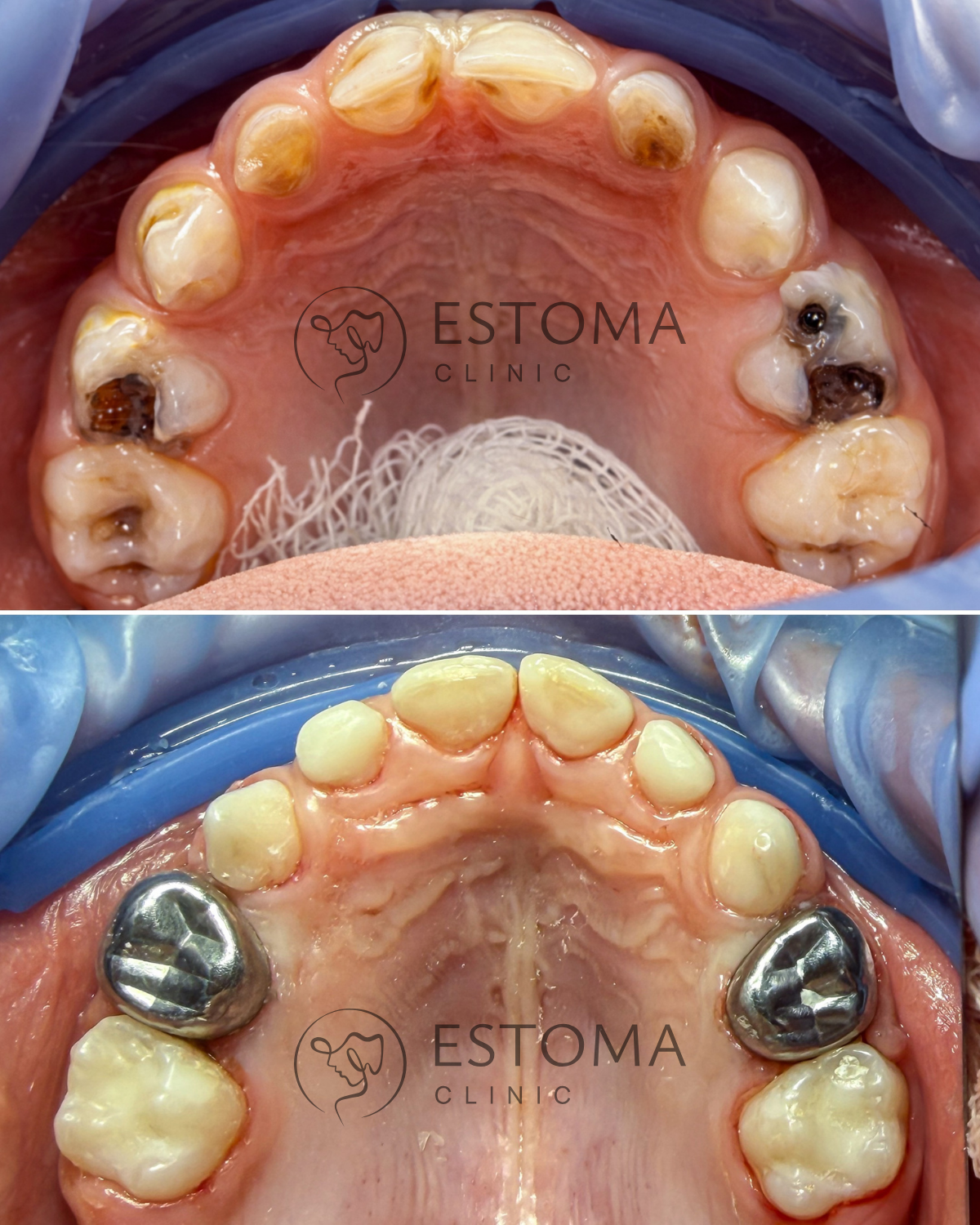 Horní zubní oblouk před a po ošetření — Estoma Clinic