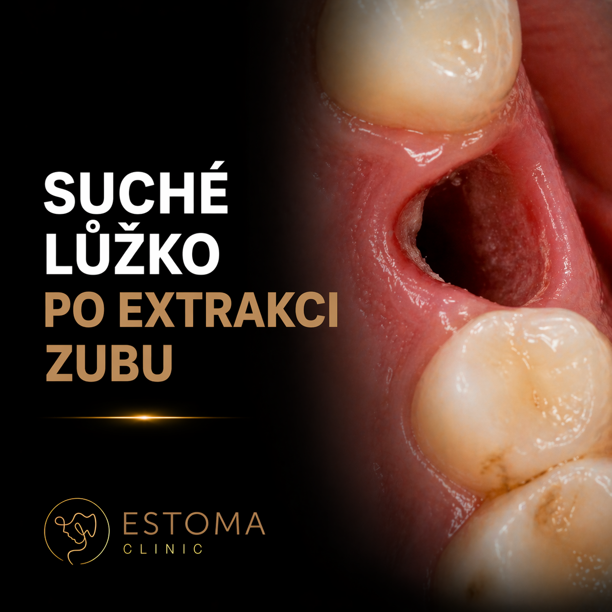 Suché lůžko po extrakci zubu: příznaky, léčba a co dělat