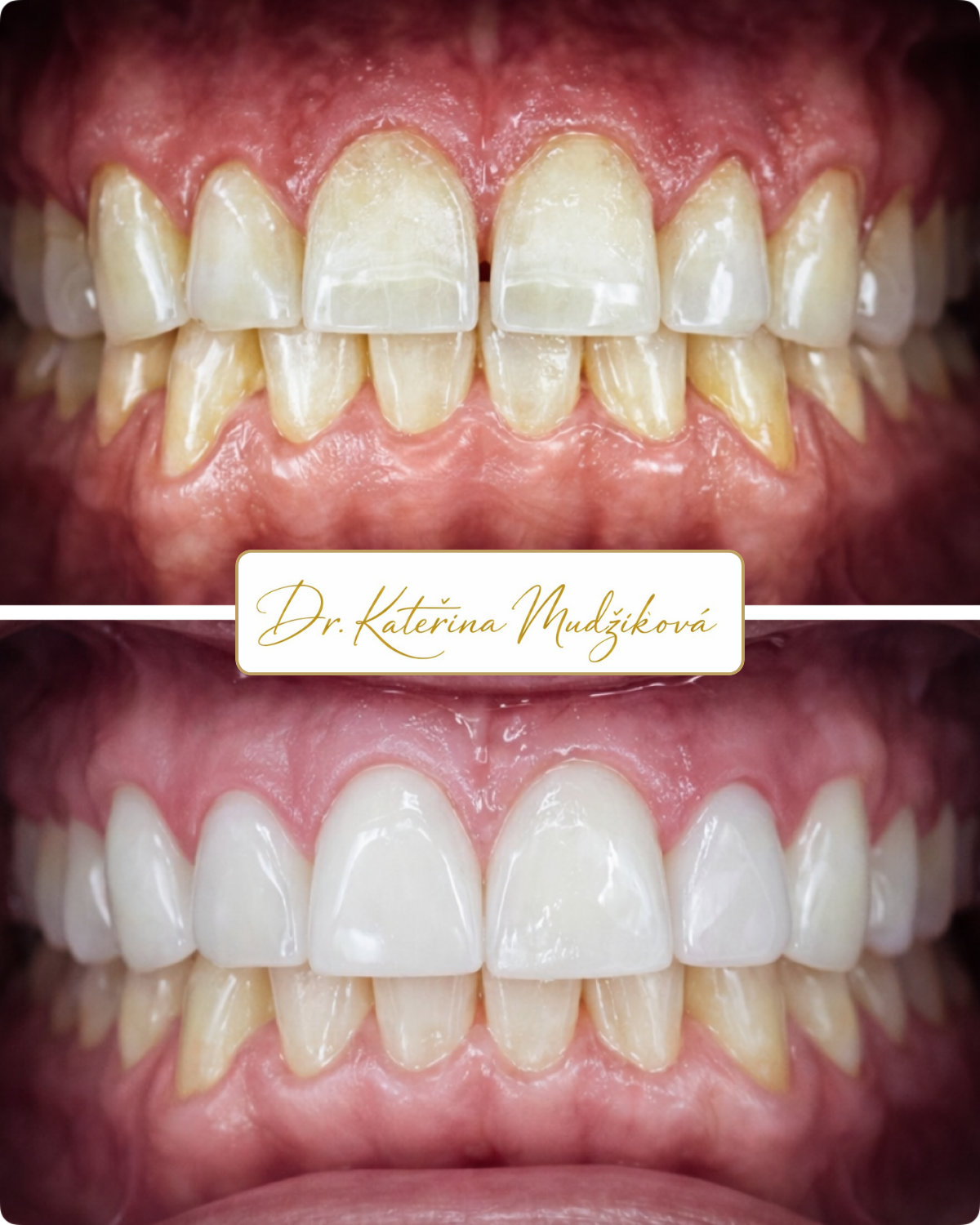 Keramické fazety — Estoma Clinic