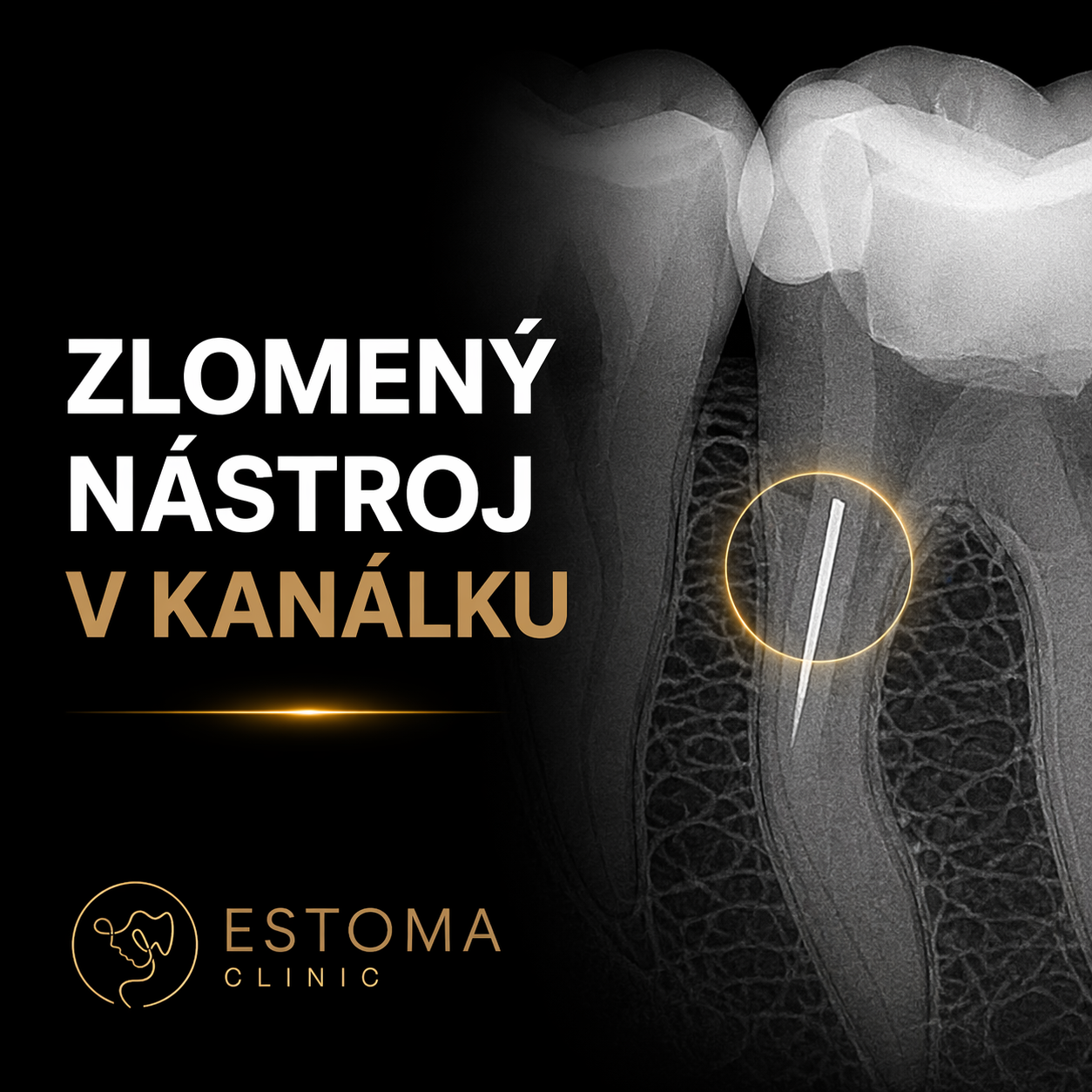 Zlomený nástroj v kanálku: co to znamená a jak se řeší